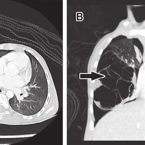 -Computed tomography scan of the multicystic pulmonary hamartoma... | Download Scientific Diagram