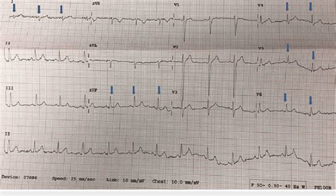 Electrocardiogram showing right axis deviation (negative QRS in lead 1 ...