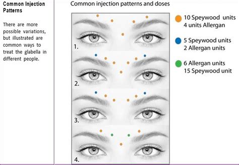 Botox Injection Sites Face Diagram - Wiring Site Resource