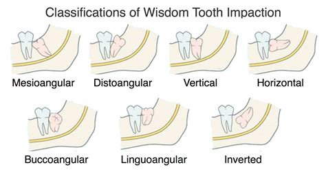 Wisdom Tooth Impaction in Ventura, CA - Pacific Oral Surgery