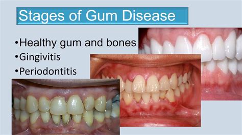 Periodontal Disease Stages