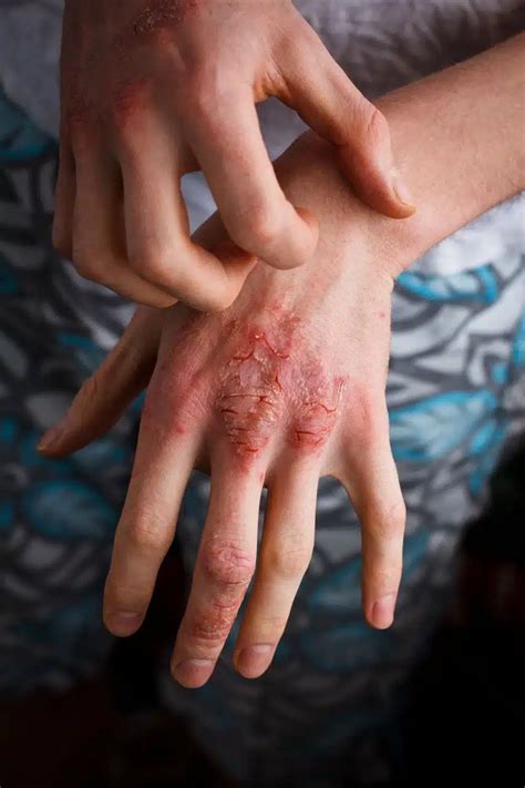 Hand eczema - National Eczema Society