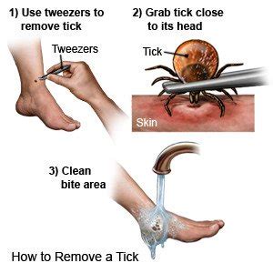 Tick Bites: What You Need to Know + Tick Removal Instructions