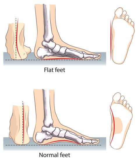 Flat Feet: Symptoms, Treatments & More | Red Mountain Footcare