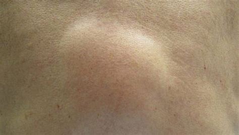 Lipoma (Skin Lumps): Causes, Diagnosis and Treatments