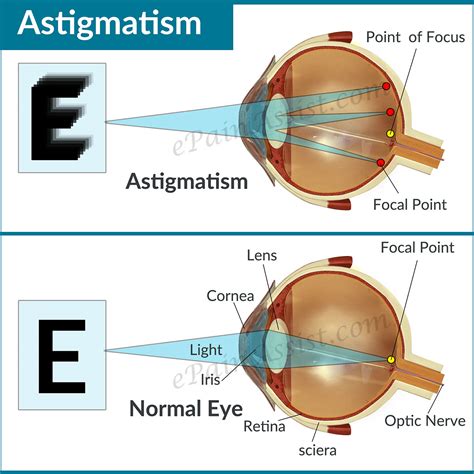 Astigmatism|Causes|Types|Symptoms|Treatment: Lenses, Refractive Surgery