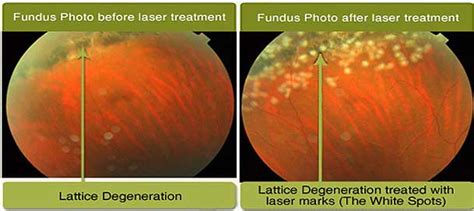 Lattice Degeneration & Retinal Detachment Risk - Preventative Treatment? - endmyopia.org