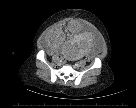 Spontaneous Hemoperitoneum – Curbside Consult