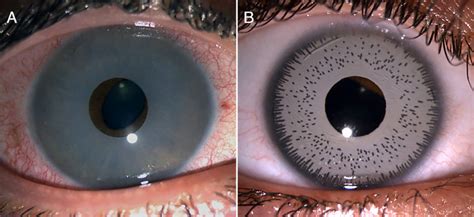 Iris Implant Surgery-Artificial Iris Implants | Eye color change surgery, Eye color change, Iris