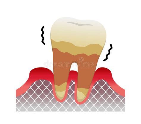 The Stages of Periodontitis Disease Illustration / Mild Periodontitis Stock Vector ...