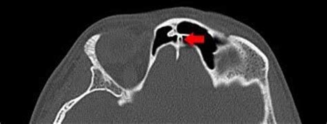 Roentgen Ray Reader: Foramen Cecum