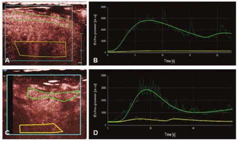 Ultrasound Perfusion Imaging: Techniques and Analytical Methods ...