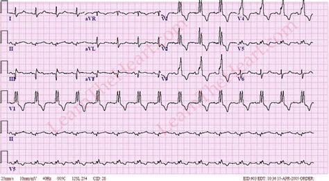 Right Bundle Branch Block ECG #2 | LearntheHeart.com