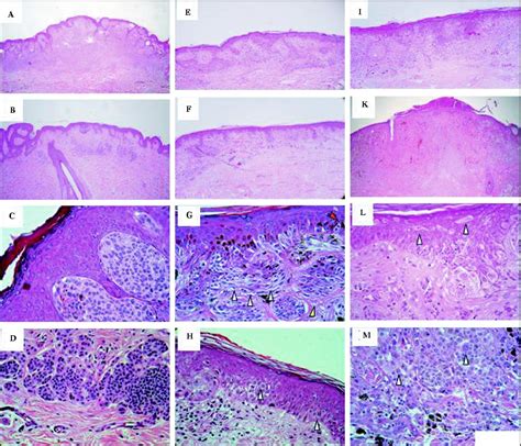 Dysplastic Nevus Histology