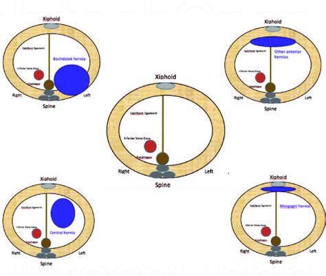 Types of congenital diaphragmatic hernia. | Download Scientific Diagram