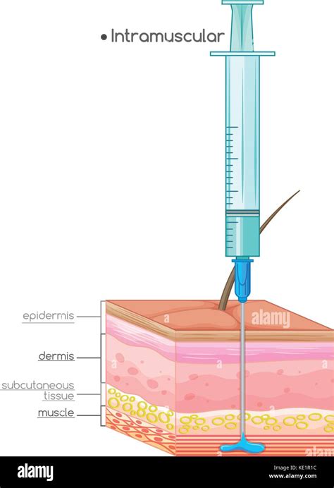 Intramuscular Injection Locations And Administration – NBKomputer