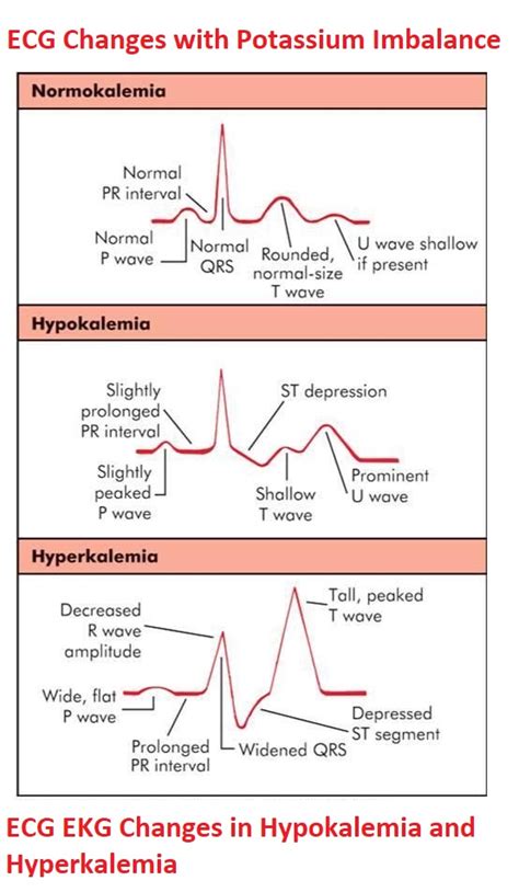 ECG/EKG Changes in Hypokalemia and Hyperkalemia - NCLEX Quiz