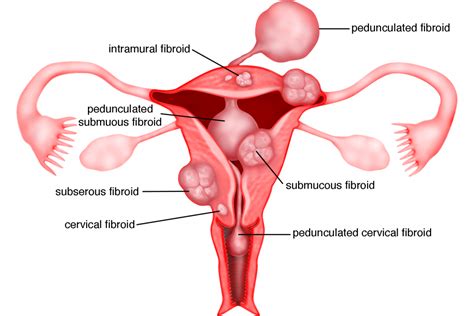 apa itu fibroid - Molly Cameron