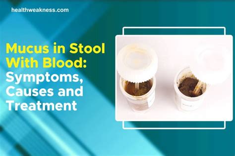 Mucus In Stool With Blood: Symptoms, Causes, Treatment 2024