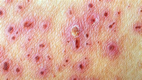 Is It Shingles Virus or Something Else? | Everyday Health