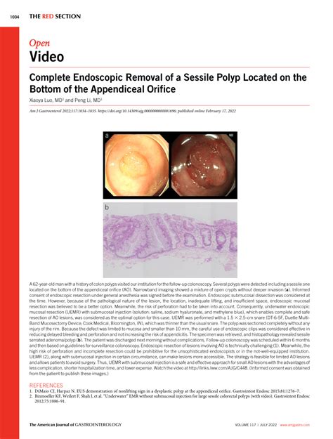 (PDF) Complete Endoscopic Removal of a Sessile Polyp Located on the Bottom of the Appendiceal ...