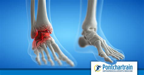 Broken or Sprained Ankle? - Pontchartrain Orthopedics & Sports Med