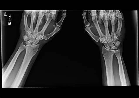 OrthoDx: Scapholunate Ligament Injury - Clinical Advisor