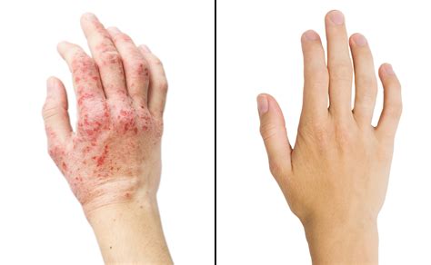 Eczema Before And After