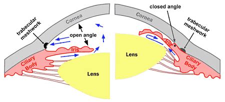 NARROW ANGLES – Toronto Eye Clinic