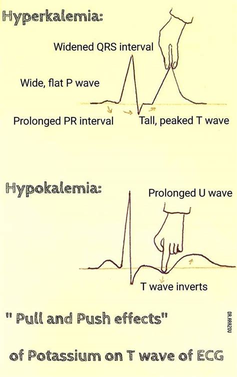 Hyper Vs Hypokalemia - Ghana tips