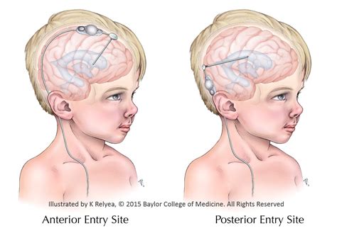 The CSF Shunt Entry Site Study | Hydrocephalus Association