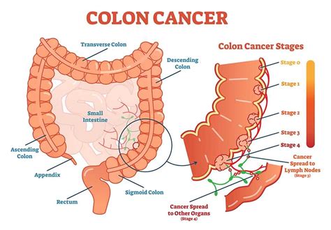 Colon Cancer; Stages, Symptoms, Causes and Screening