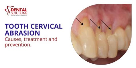 Tooth Cervical Abrasion, Causes, Treatment and prevention - Best Dental ...