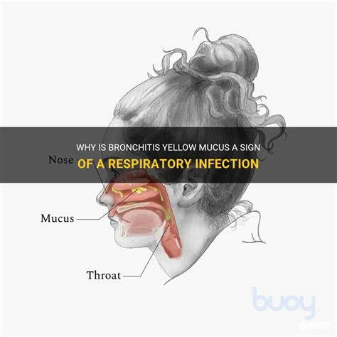 Why Is Bronchitis Yellow Mucus A Sign Of A Respiratory Infection | MedShun