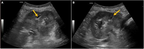 Frontiers | Case report: Emphysematous pyelonephritis associated with kidney allograft abscess ...