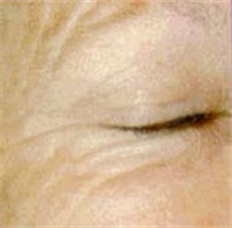 Newport Beach Wrinkles Treatment | Remove Fine Lines Orange County