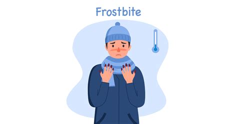 Frostbite: Symptoms, Causes, & First Aid Guide