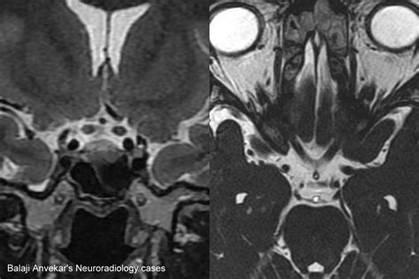 Dr Balaji Anvekar FRCR: Optic Nerve Atrophy MRI