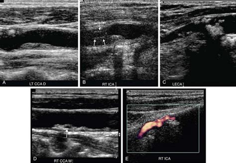 Ultrasound Of Carotid Artery