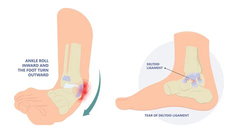 How to Heal a Torn Deltoid Ligament - Regenexx