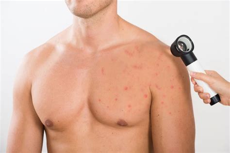 Chest Acne: Facts, Causes, Prevention, and Treatments | Consumer Health Weekly