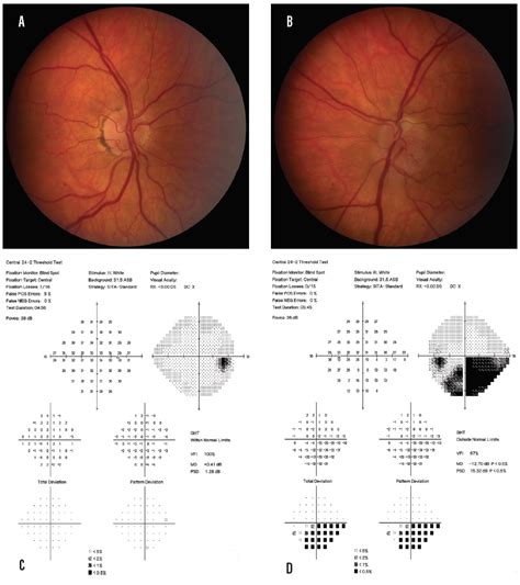 NAION: What to Do and When - Glaucoma Today