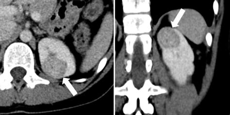 CEUS shows kidney mass is benign after CT suggests cancer - International Contrast Ultrasound ...