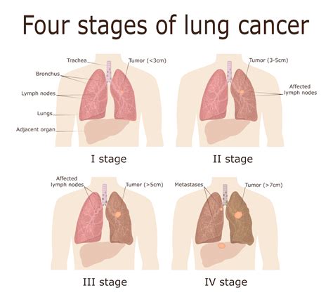 Lung Cancer Awareness - Saint John’s Cancer Institute Blog