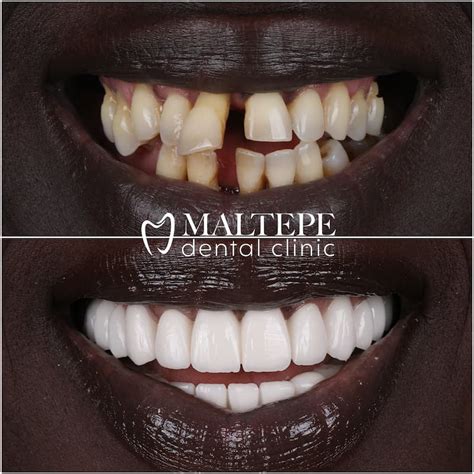 Buck teeth: Cause and Treatment - Maltepe Dental Clinic