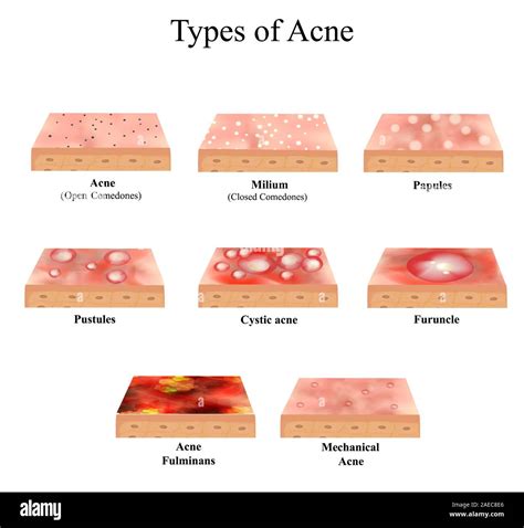 Types of Acne Skin inflammation. Pimples, boils, whitehead, closed ...