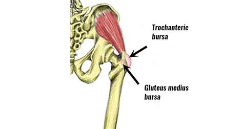 Hip Bursitis - Trochanteric bursitis - Symptoms, Causes & Treatment