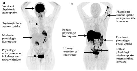 Normal Pet Scan Images