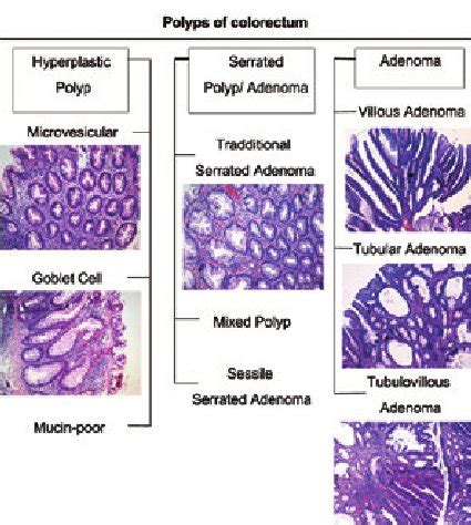 Colonoscopy Polyps Types