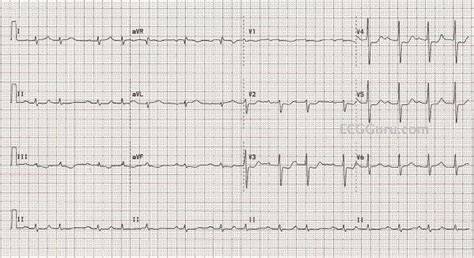 NSTEMI | ECG Guru - Instructor Resources